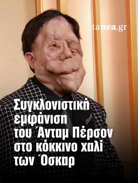 ΔΕΝ ΕΙΝΑΙ «Frankenstein’s monster” (το τέρας του Φρανκενστάιν)– ΕΙΝΑΙ Ο ADAM PEARSON: ΕΝΑ ΙΣΧΥΡΟ ΜΗΝΥΜΑ ΑΠΟΔΟΧΗΣ ΣΤΟ ΚΟΚΚΙΝΟ ΧΑΛΙ ΤΩΝ ΟΣΚΑΡ
